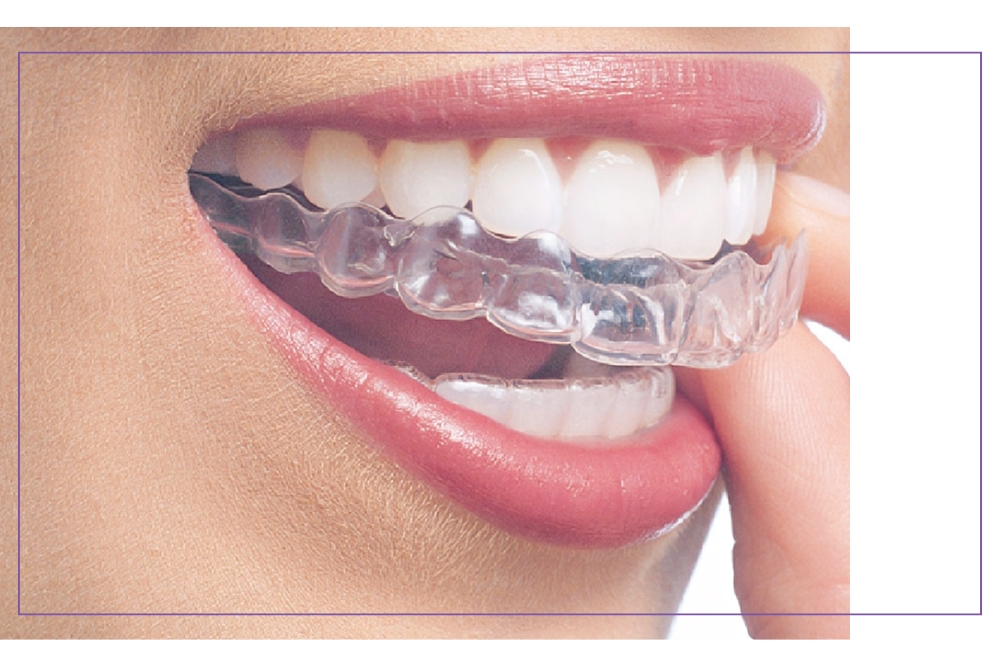 Alignery nakładki ortodontyczne przezroczyste