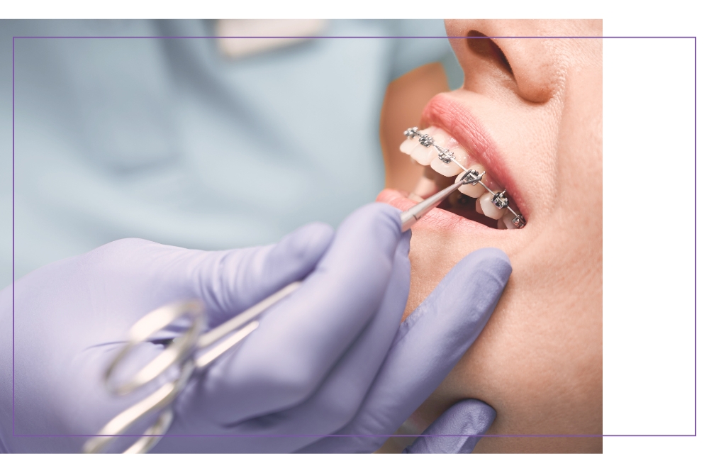 Leczenie ortodontyczne